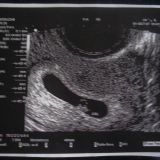 1.10.2007 otettu ultrakuva äitin pikkuisesta, erotatko tuossa vauvan? =P
